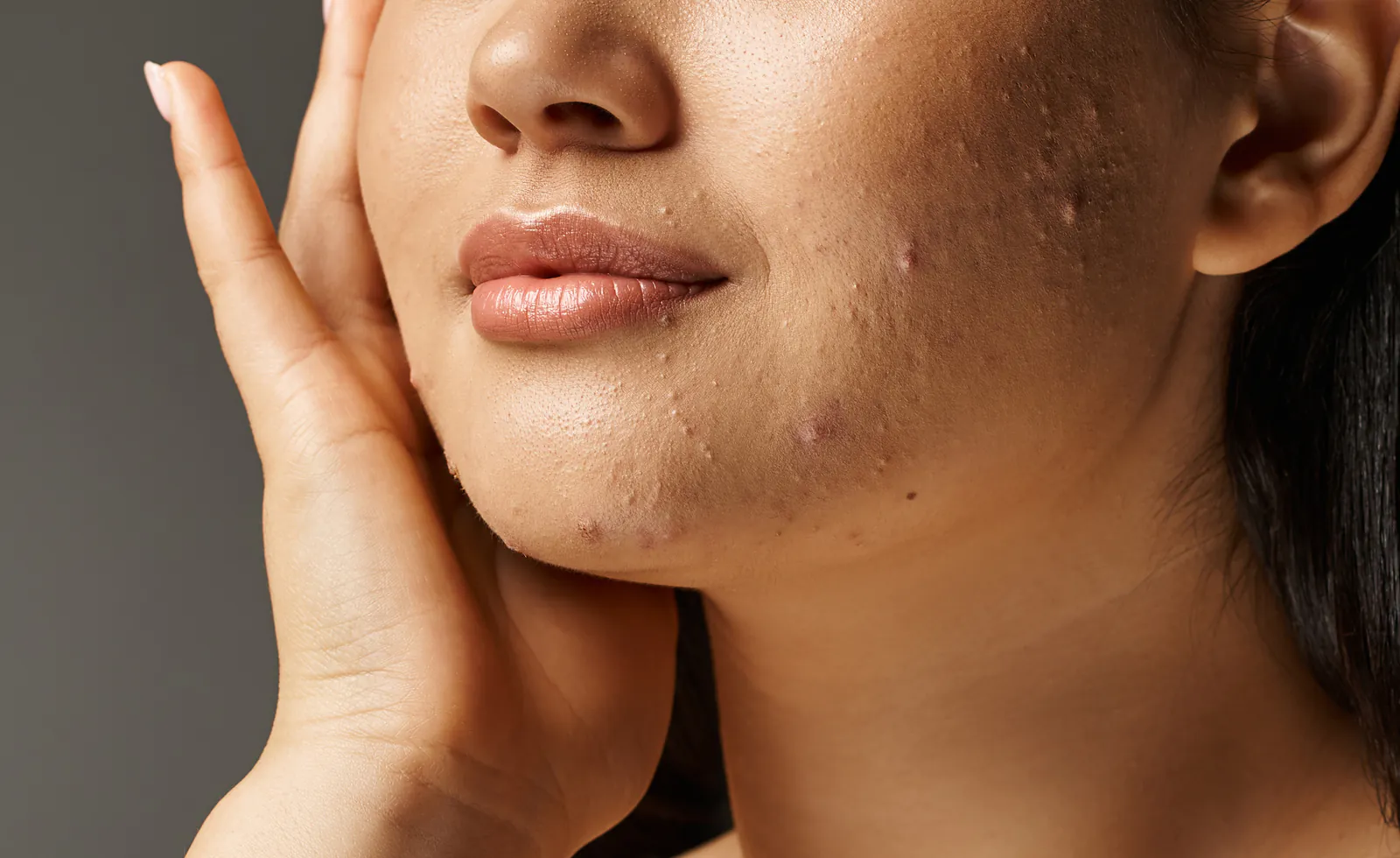 Before: cheek and jaw with breakouts and uneven texture
